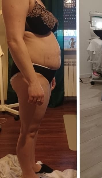 Sylwetka z profilu przed serią zabiegów