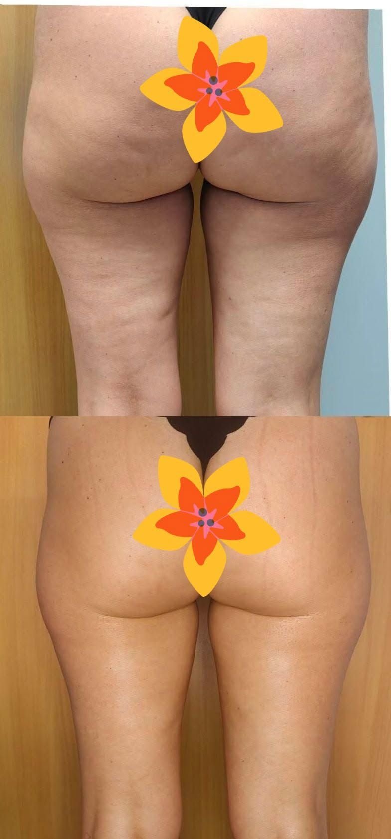 Uda i pośladki przed i po serii masaży modelujących